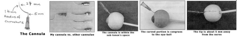 Five panels. First, a labelled drawing of the cannula giving a 27 mm curved portion, a 5 mm straight portion and a 14 mm radius of curvature. Second, the cannula photographed beside four other cannulae for comparison. Third, fourth and fifth, the cannula on a model eye, showing it lying within the sub-Tenon's space, its curve matching the eyeball, and its tip about 5 mm short of the optic nerve.